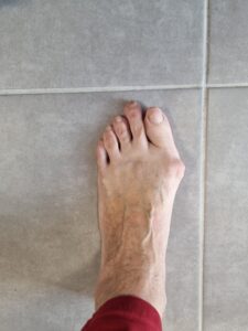 Illustration d’un pied grec avec index minus (deuxième orteil plus long) Illustration of a Greek foot with index minus (longer second toe)