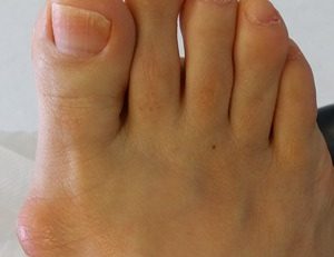 hallux-avant Hallux valgus avant chirurgie, déviation du gros orteil, Dr Richard Borgi